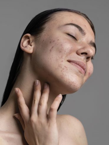 Mulher branca com pele acneica