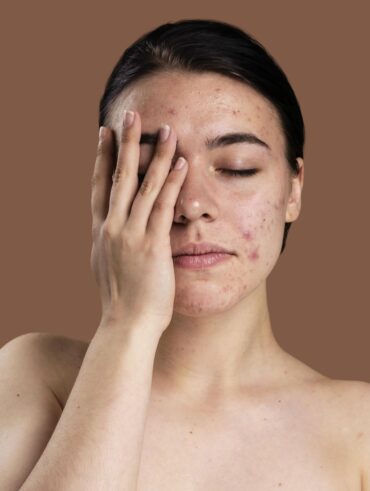 Cuidados com a oleosidade e a acne no verão