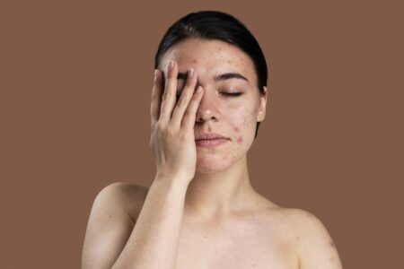 Cuidados com a oleosidade e a acne no verão