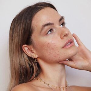 Mulher de pele clara, com cabelo loiro, acessórios em dourado e pele acneica