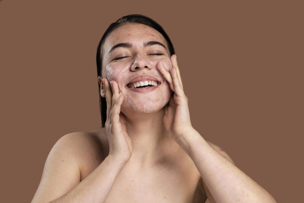 Cuidados com a pele para tratar acne