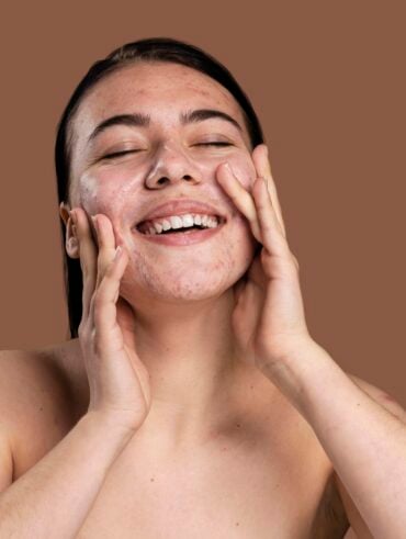 Cuidados com a pele para tratar acne