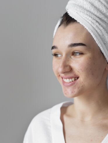 Como tratar as cicatrizes de acne
