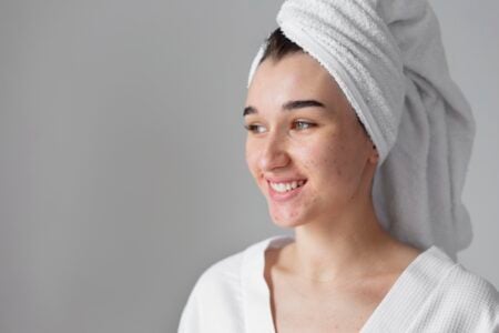 Como tratar as cicatrizes de acne