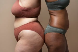 Como descobrir se tenho lipedema?