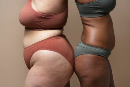 Como descobrir se tenho lipedema?