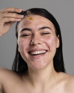 Mulher de pele clara e acneica, com cabelo escuro. Ela está aplicando algum sérum