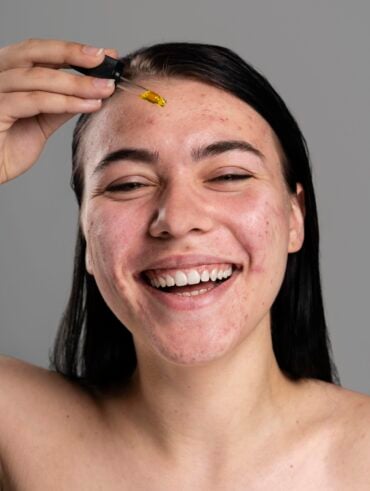 Mulher de pele clara e acneica, com cabelo escuro. Ela está aplicando algum sérum